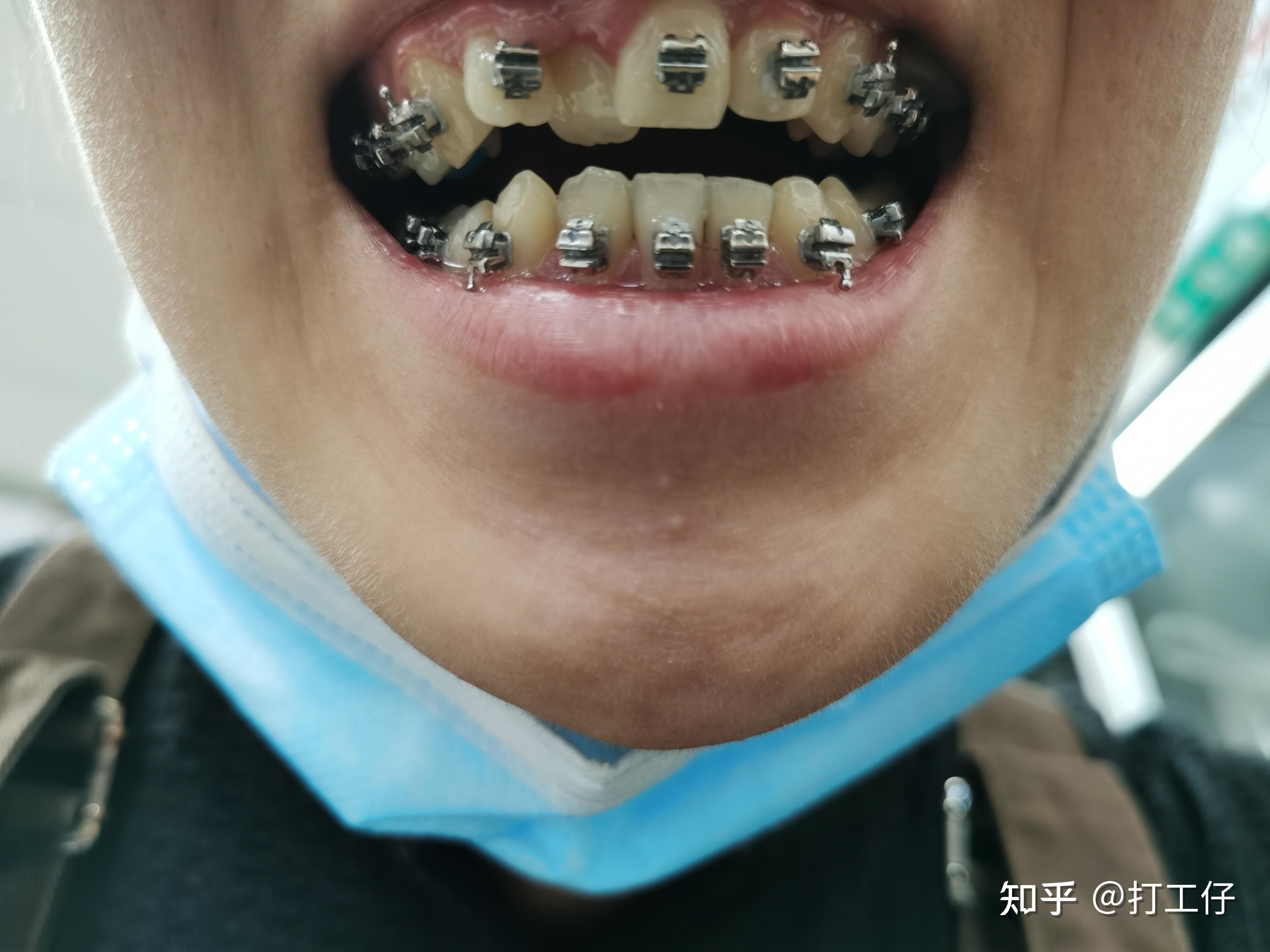 钢牙大鼻_大钢牙_钢牙大王图片