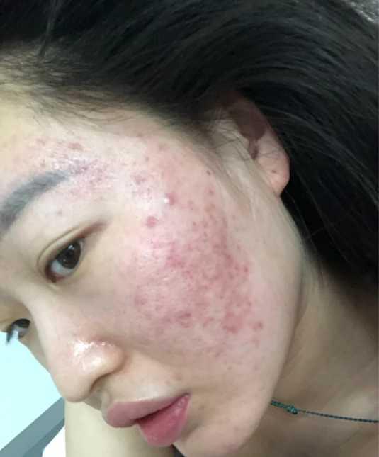 痘印下载软件_痘印手机游戏_痘印小游戏怎么玩
